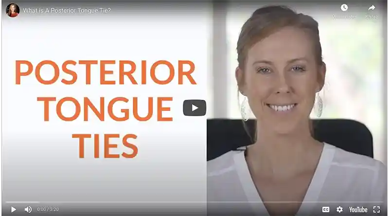 What is a posterior tongue tie?